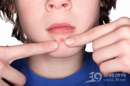 痘痘告诉你哪里生病了