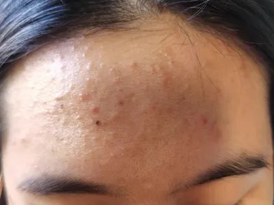 痤疮前额丘疹图片