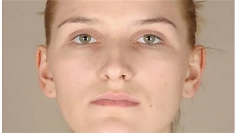 眼角鱼尾纹去除方法