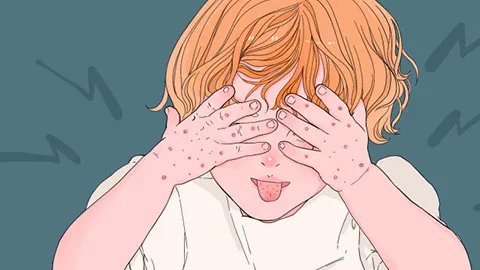 婴儿消化不良性腹泻怎么办