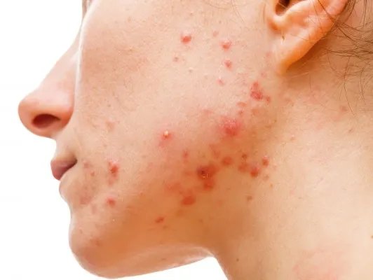 面部痤疮怎么办