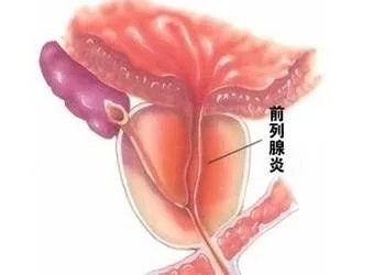 北京前列腺症状及治疗?