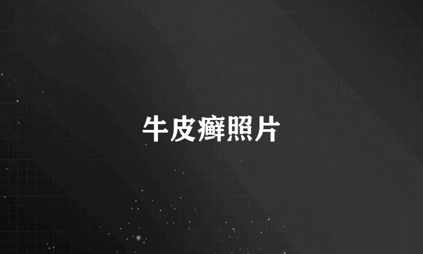 牛皮癣照片