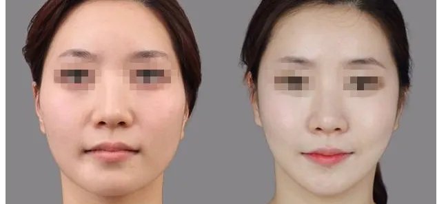 改脸型手术的价格