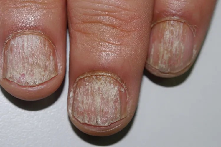 指甲顶针状凹陷图片