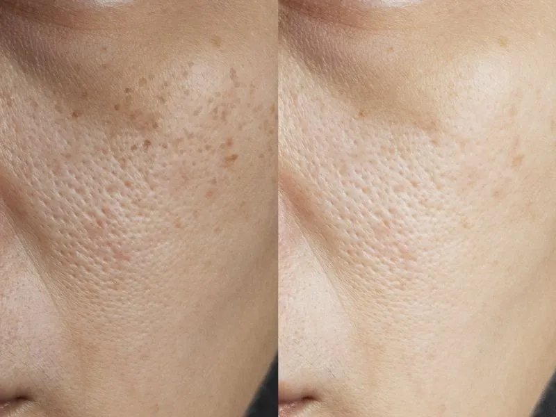 冬季该如何保护自己的皮肤