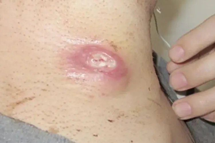 皮肤钙质沉着症颈部肿块图片