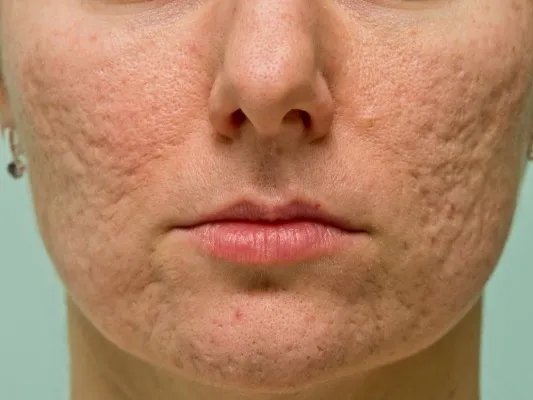 怎样去掉脸上的痘坑