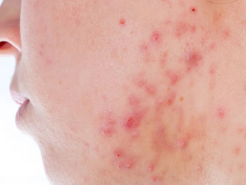 脸上有痘印怎么去