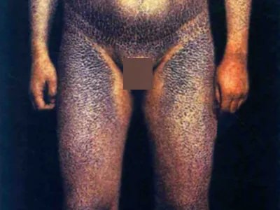 X连锁鱼鳞病全身症状图片