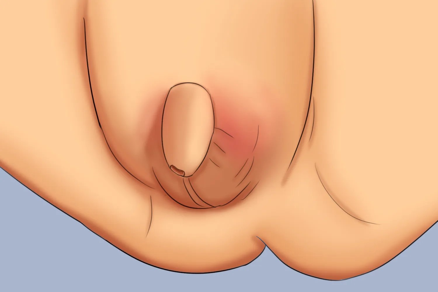 小孩包茎的症状和图片