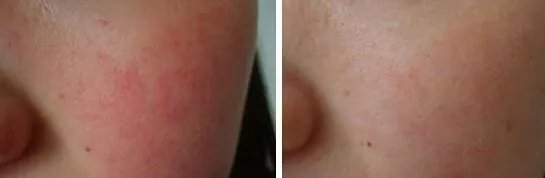 彩光嫩肤去红血丝效果好吗