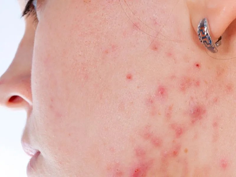 如何去除青春痘疤痕