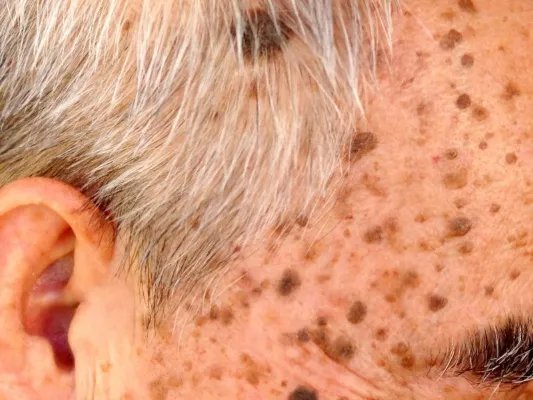 怎样防止老年斑出现