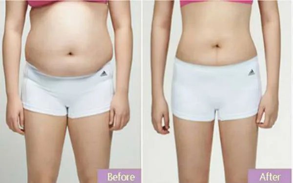 做个全身吸脂要多少钱