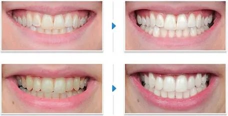 激光美白牙价格