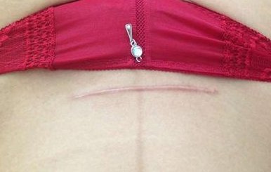 手术疤痕治疗需要怎样修复