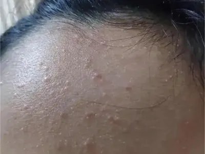 痤疮前额丘疹图片