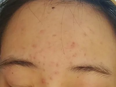 痤疮前额丘疹图片