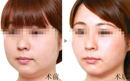 整容瘦脸针多少钱呢