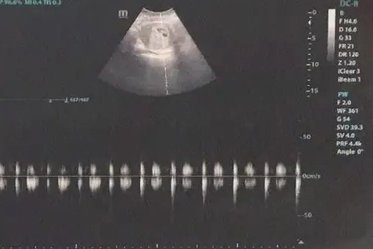 怀孕40天左右B超图片