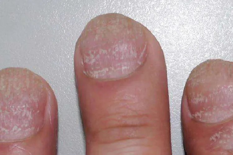 指甲顶针状凹陷图片