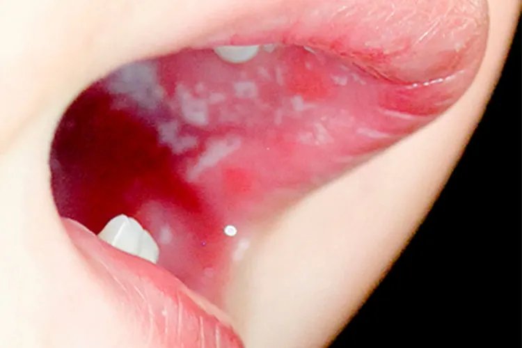 婴儿鹅口疮的图片