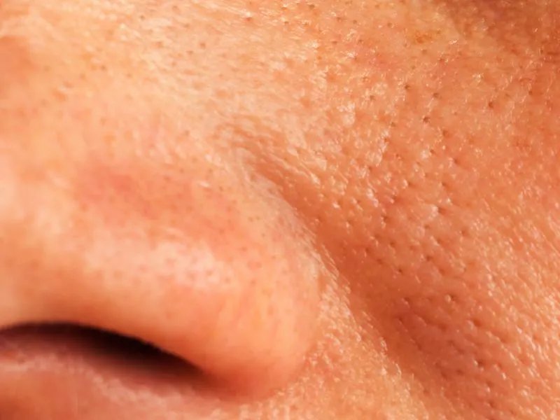 脸上皮肤粗糙毛孔大怎么办