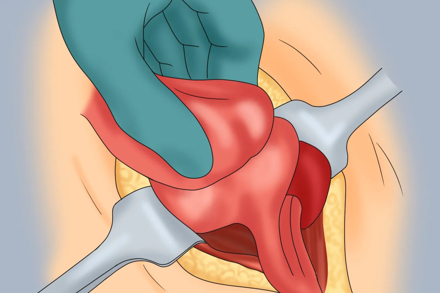 阑尾炎手术图片