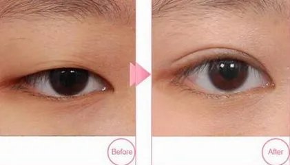 北京哪里做双眼皮效果比较好