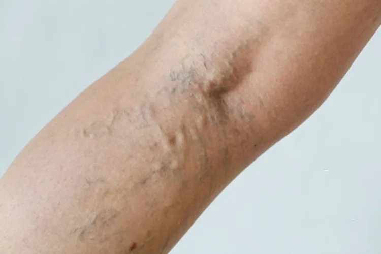 脉管炎早期症状图片