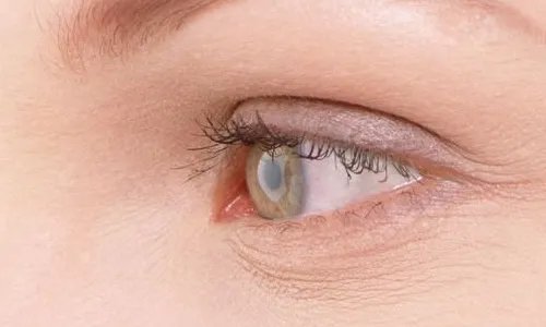 韩式定点双眼皮缺点