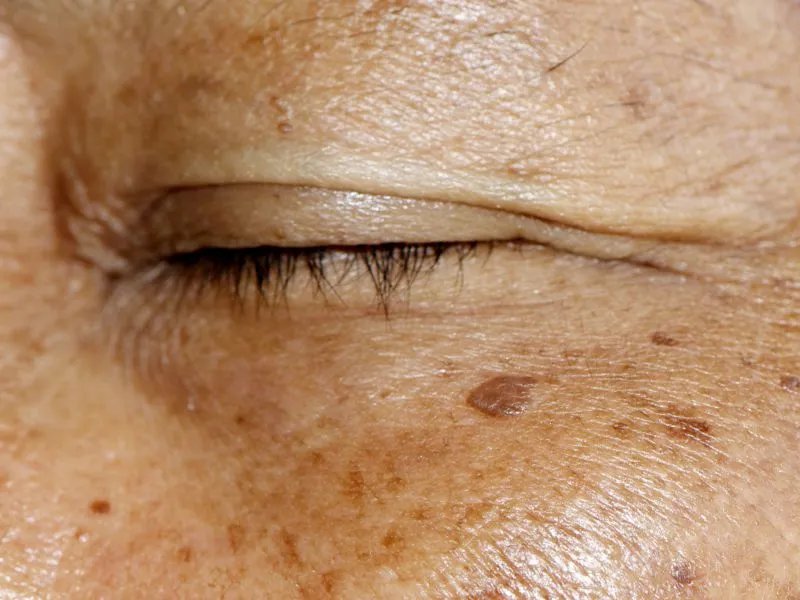 脸颊长黄褐斑怎么办