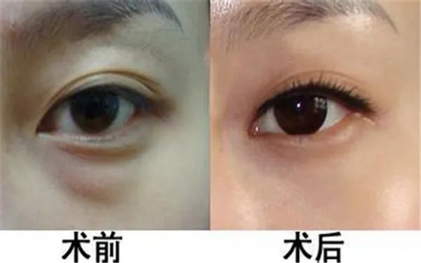 溶脂祛眼袋价格