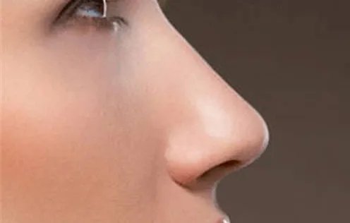 鼻翼缩小手术价格