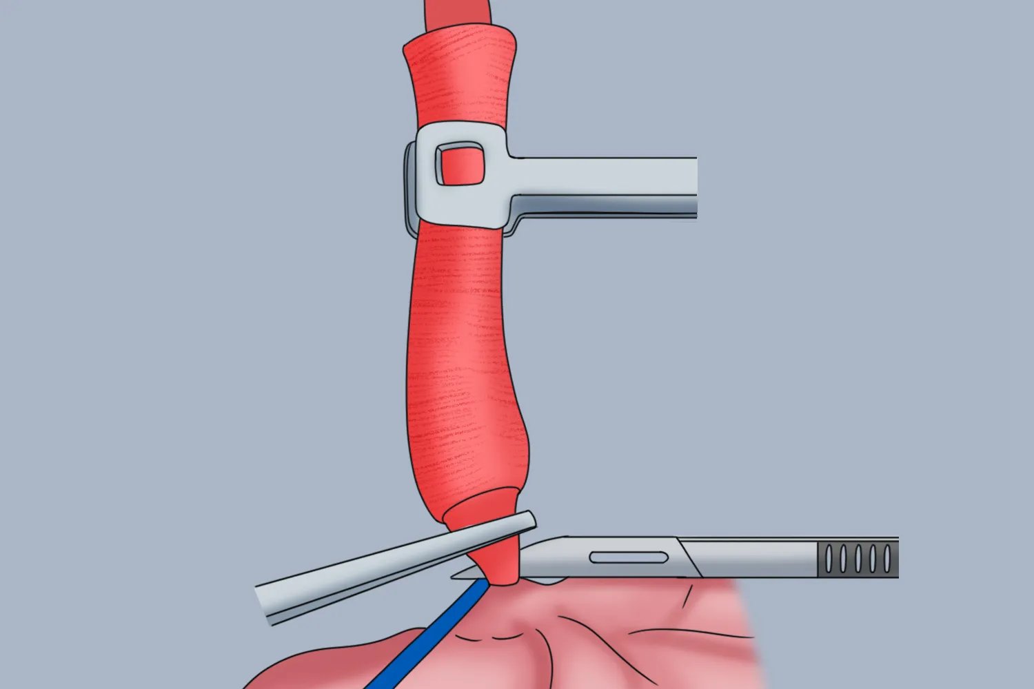 阑尾炎手术图片