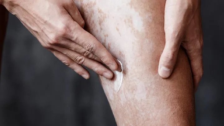 白癜风治疗方法有哪些