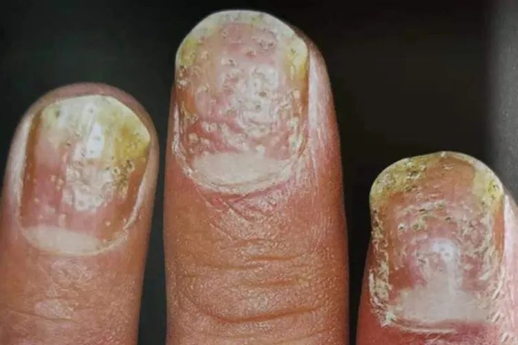 指甲顶针状凹陷图片