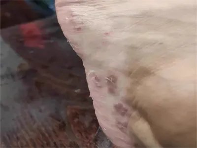 水疱型足癣疙瘩图片