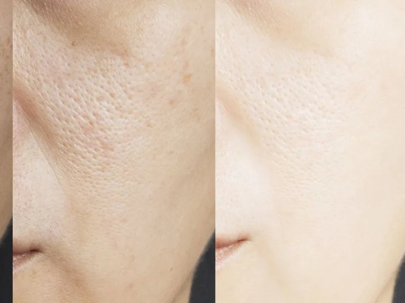 如何快速美白肌肤