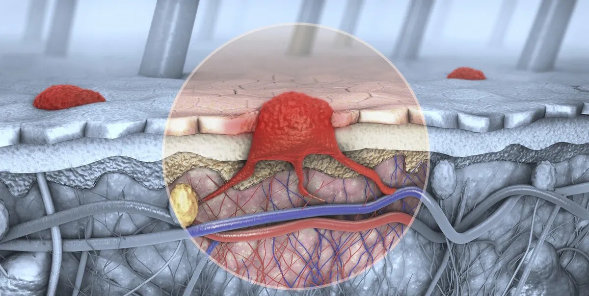 除了指甲和头发，全身都有可能长癌！人体最易患癌的15个部位