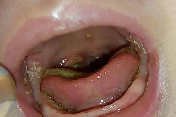 婴儿鹅口疮的图片