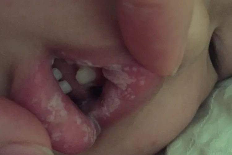 婴儿鹅口疮的图片