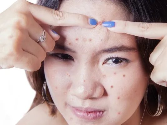 像素激光祛痘怎么样