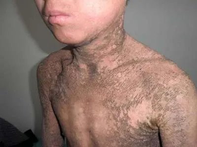 X连锁鱼鳞病全身症状图片