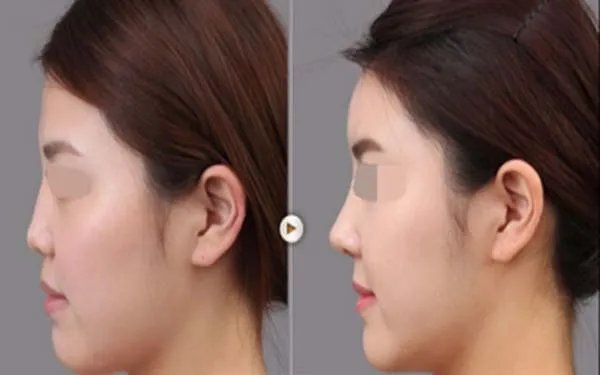 隆鼻可以保持多久	