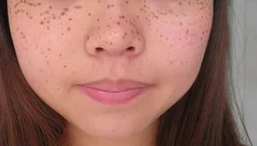 光子祛斑多少钱