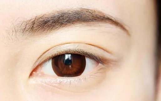 外眼角开大多久能好