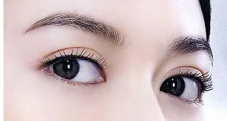 北京双眼皮手术多少钱