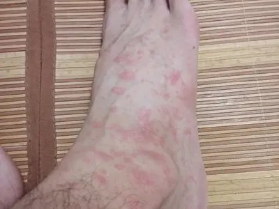 皮肤过敏红肿脚背疙瘩图片